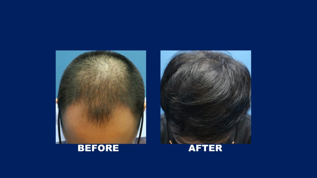 Before and After Treatment of FUE Hair Transplant