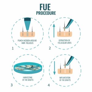 Simple Graphical Explanation of FUE Hair Transplant Process