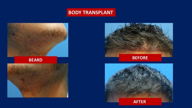 body hair transplant result