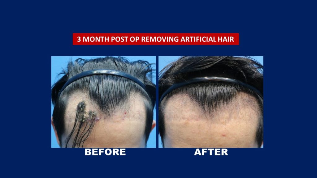 corrective hair transplant result