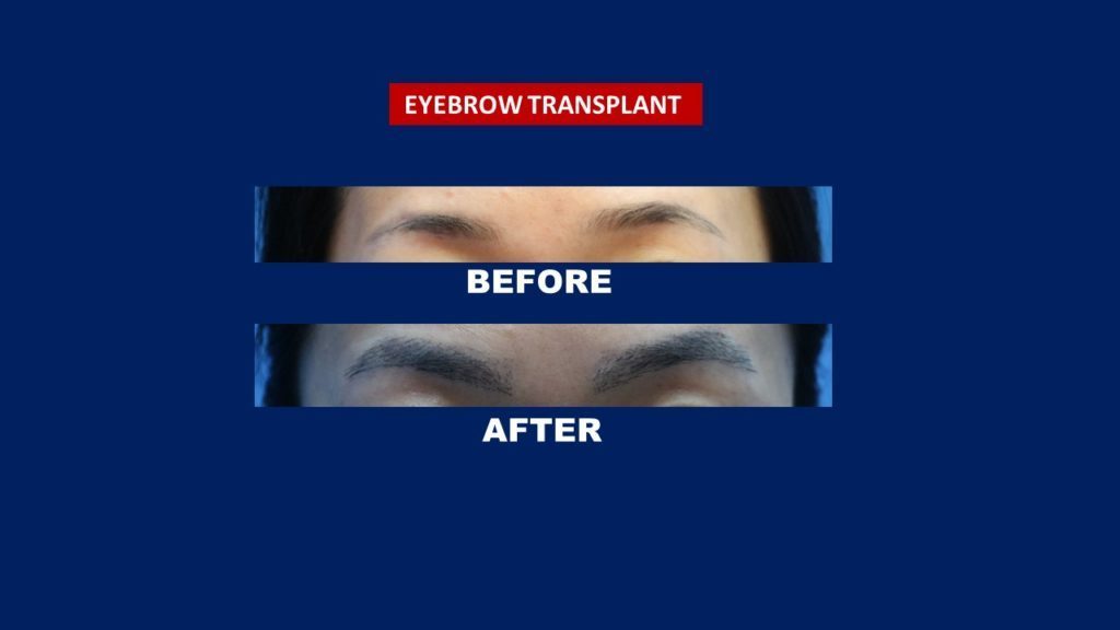 eyebrow transplant before and after