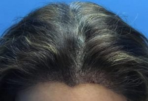 fue female 1 week result post care protocol