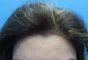 fue female 14 month result post care protocol