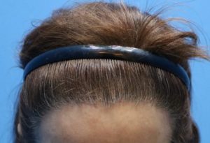 fue female 6 month result post care protocol