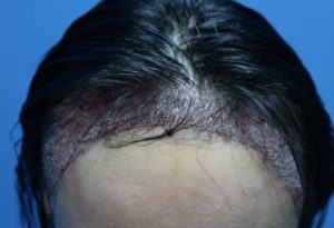 fue female day 1 result post care protocol