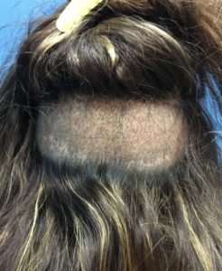 fue female donor 1 week response post care protocol