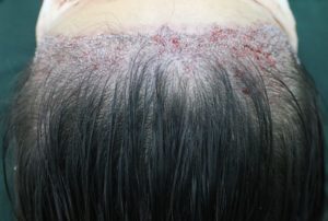 fue female immediate result post care protocol