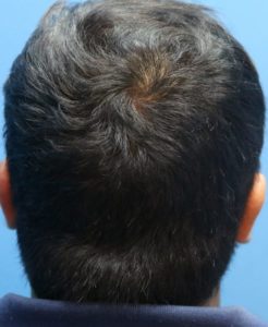 fue male donor 14 month result post care protocol