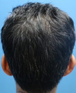 fue male donor 6 month result post care protocol