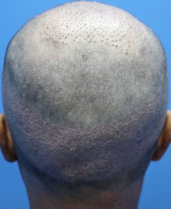 fue male donor day 1 result post care protocol