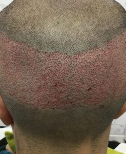 fue male donor immediate result post care protocol