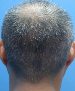 fue male donor two week result post care protocol