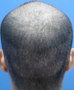 fue male donor week 1 result post care protocol