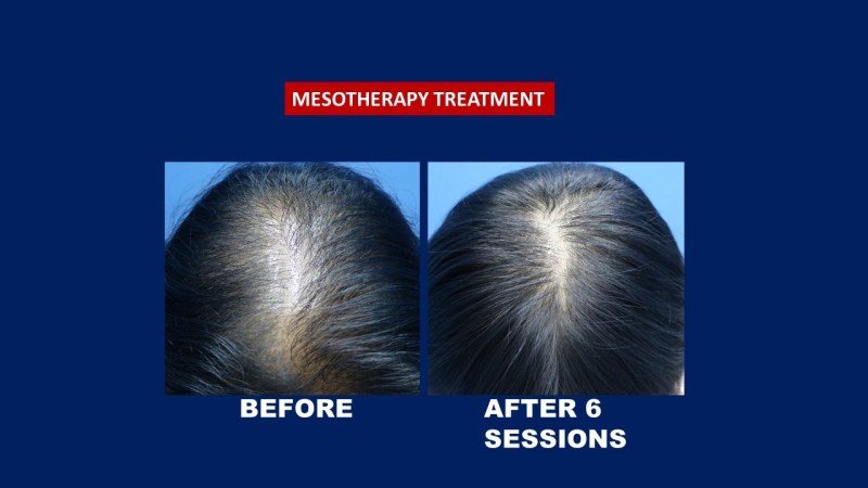 Mesotherapy result before and after