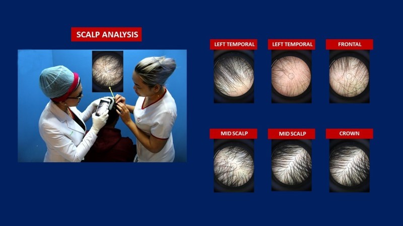 scalp analysis for Hair Transplant