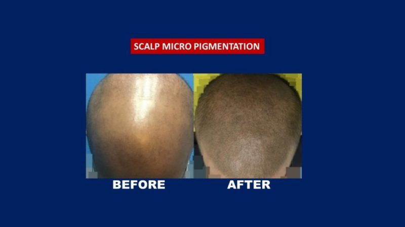 The result image of scalp micro pigmentation before and after treatment