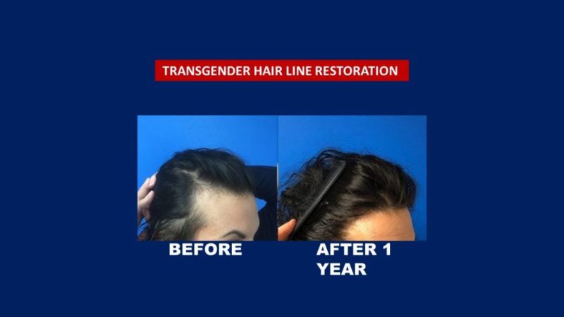 transgender hair transplant result treatment