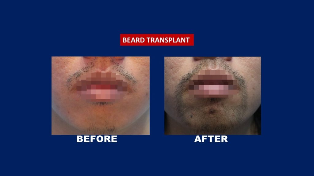 beard transplant before and after