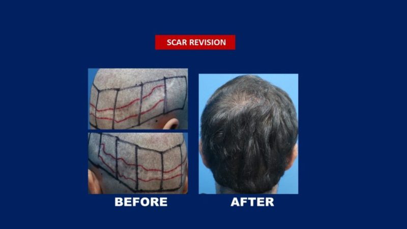 scar revision on the scalp before and after